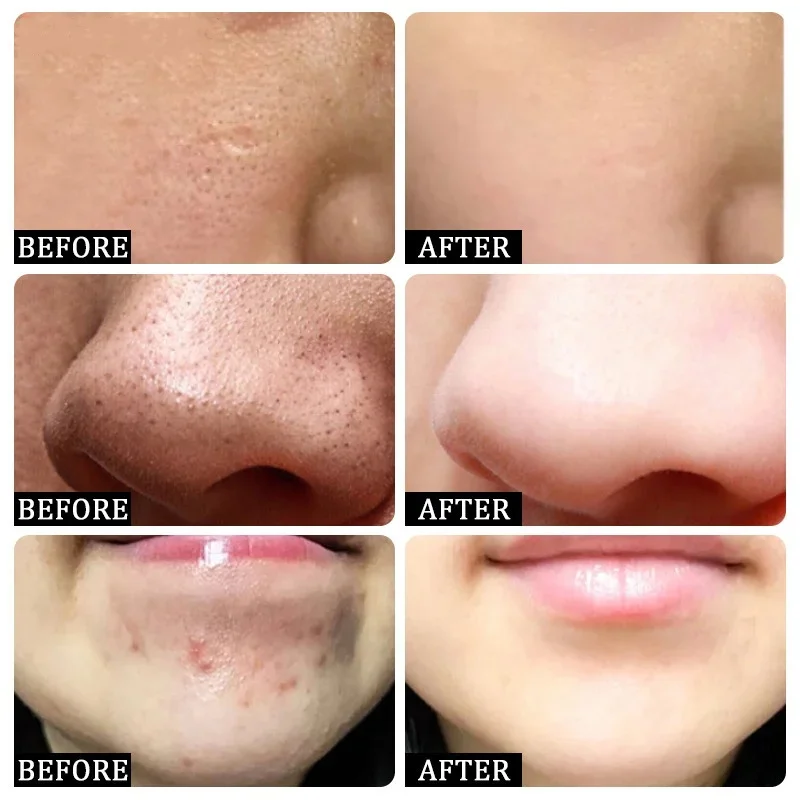 Salicylic Acid Pore Clearing C – обзор и цена Azelaic Acid Cream