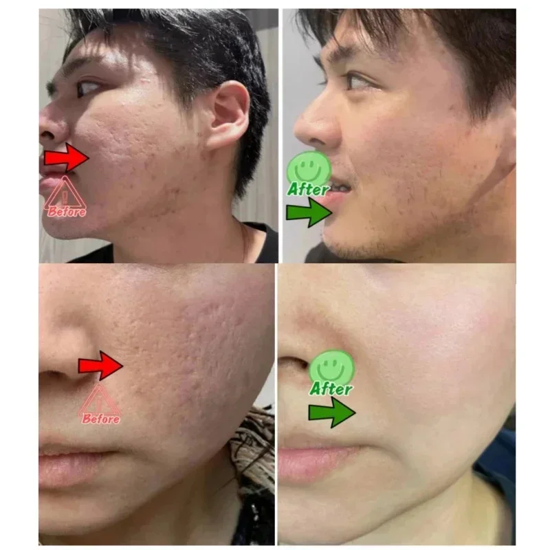 Salicylic Acid Pore Clearing C – обзор и цена Azelaic Acid Cream