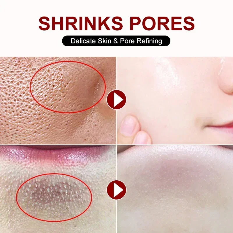 Salicylic Acid Pore Shrinking  – обзор и цена Azelaic Acid Cream