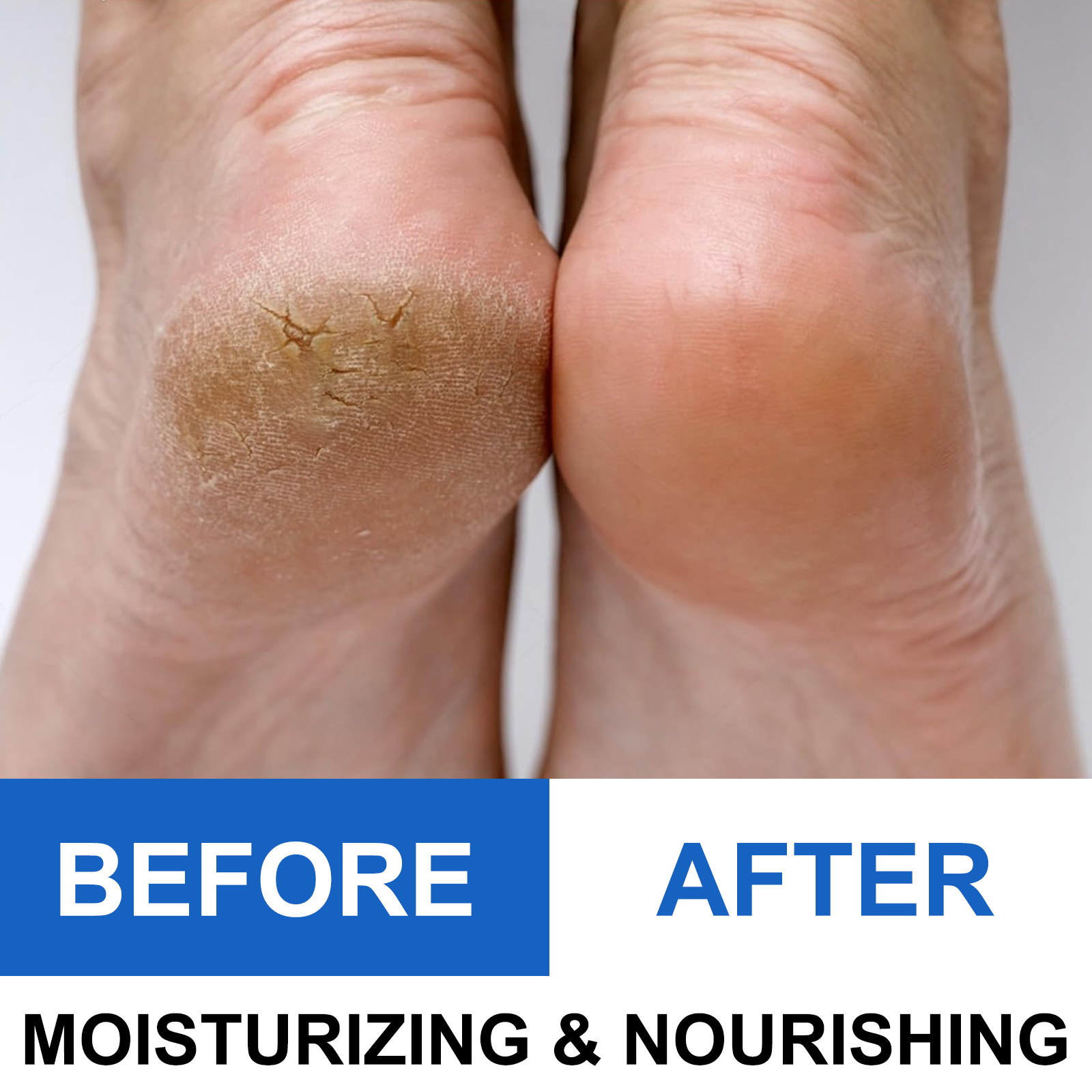 40% Urea Foot Cream Stick - Mo – обзор и цена Azelaic Acid Cream