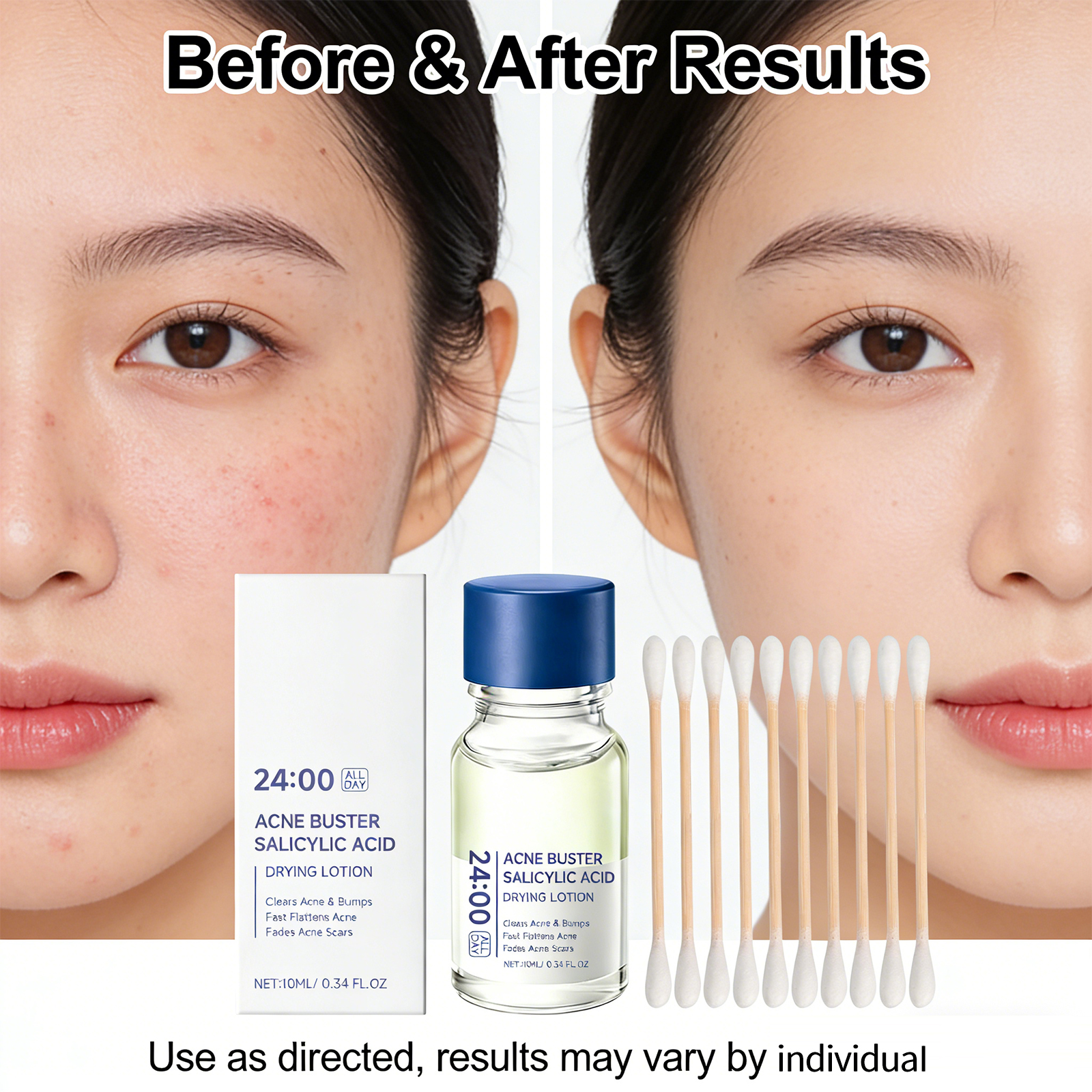 Salicylic Acid Drying Lotion F – обзор и цена Azelaic Acid Cream